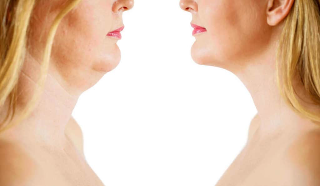 Double Chin treatment Godalming before and after results