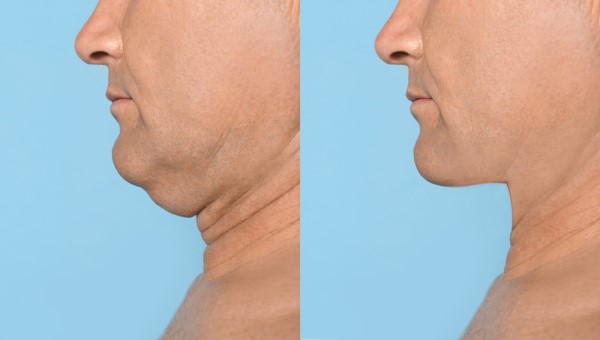 Which Non-Surgical Treatments Work Best for Jowls and Loose Skin Godalming?