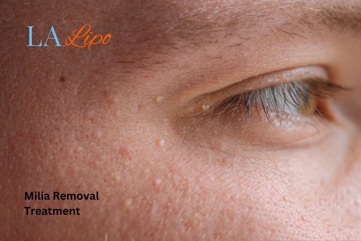 Cryopen Milia Removal: Is It the Easiest and Safest Option Godalming?