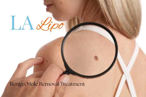 Why getting moles removed Godalming can boost your confidence!