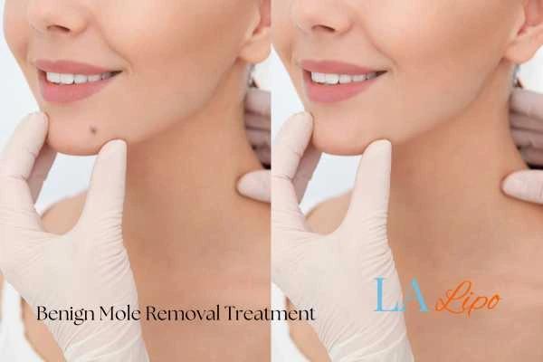 woman's before and after mole removal Godalming results