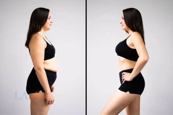image of woman before and after results of LA-EMS Body Sculpting Godalming to help treat Diastasis recti