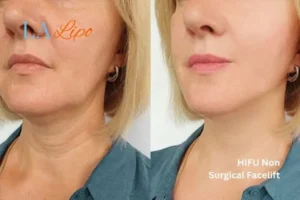 hi-fu for wrinkles Godalming before and after results