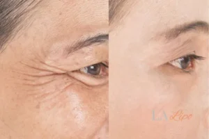 Before and after results of woman - HI-fu wrinkles reduction treatment Godalming