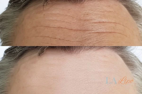 results of HIFU Godalming on mans forehead to help reduce lines and wrinkles