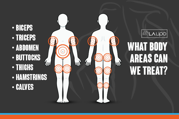 Graphic to show areas you can have LA-EMS Body Sculpting Godalming treatment.