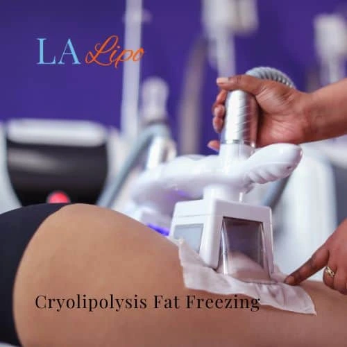 fat freezing - Cryolipolysis Godalming