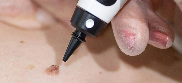 skin tag removal using cryopen Godalming