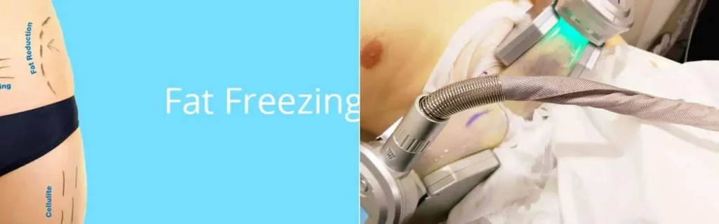 multi areas of a persons body having coolsculpting Godalming treatment