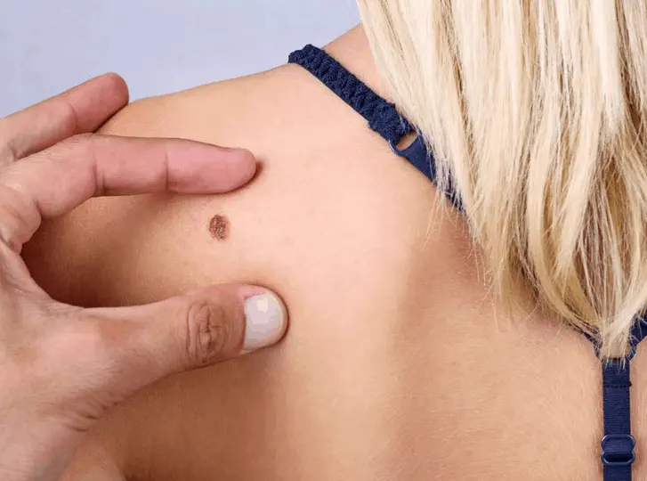 woman having mole removal Godalming consultation before treatment.