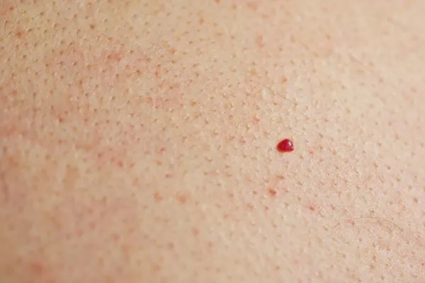 close up of a cherry angioma Godalming
