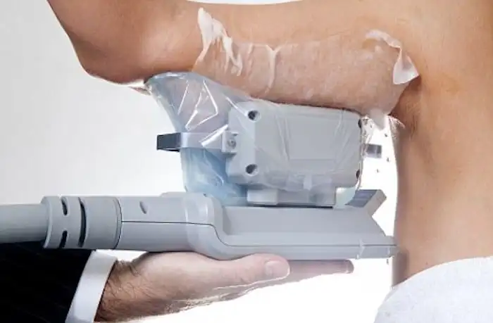 Picture of fat freezing Godalming on the upper arms.