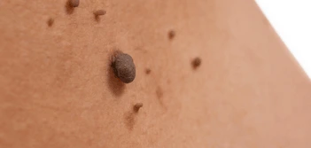 image of a skin tag Godalming