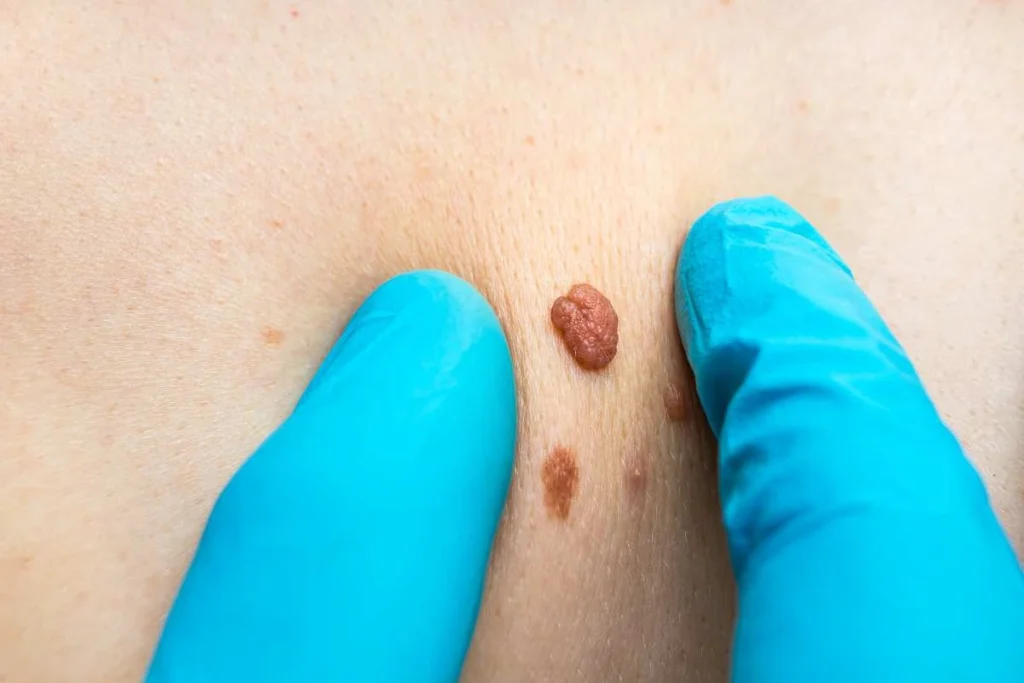 Consultant examining a skin tag Godalming