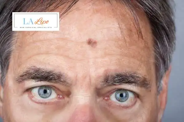 Solar Lentigo Removal Godalming image of man with mark on his forehead