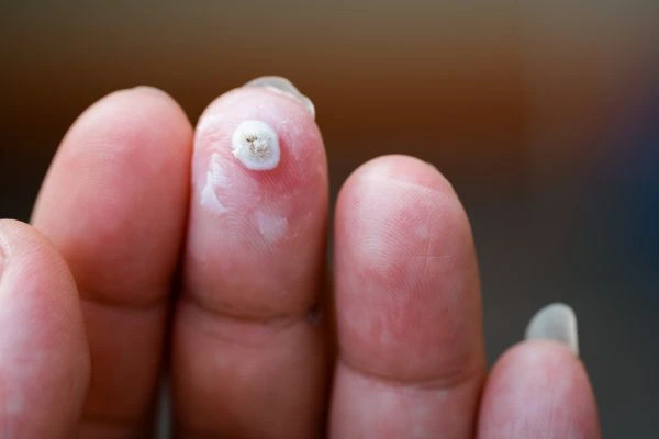 wart on person finger - cryotherapy to treat from LA LIPO Godalming