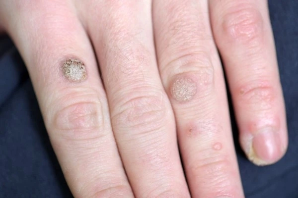 photo of warts on person hand - see wart removal Godalming from LA LIPO