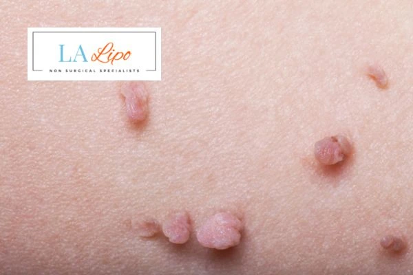 Does cryopen skin tag removal Godalming hurt? Find out now call our team today!