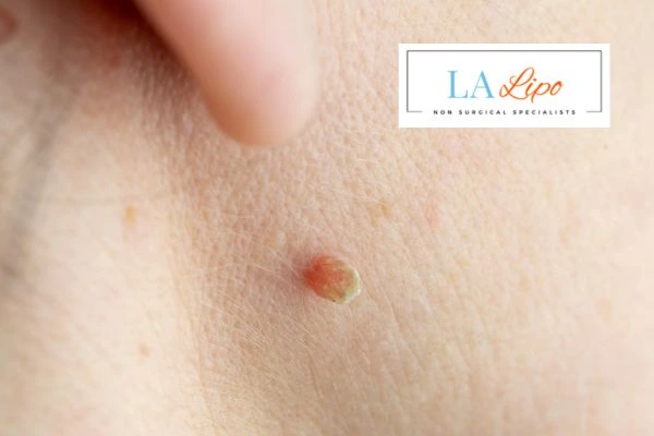 Book skin tag removal Godalming today speak to our team now!