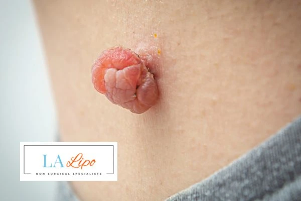 Interested in skin tag removal Godalming? Concerned about the pain? Find out more today!