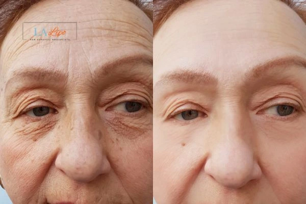 The powerful benefits of Morpheus8 Treatment Godalming - Call Our team today!