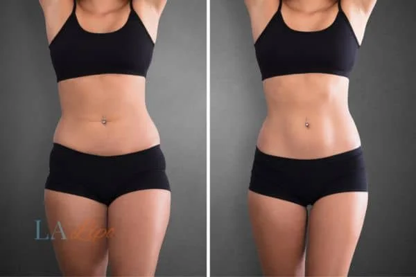 before and after results of non-surgical treatment to help a woman's body image and mental health Godalming
