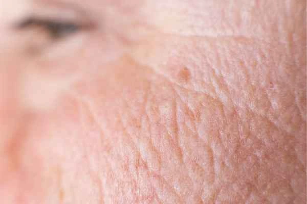 close up picture of a woman's face showing an age spot Godalming