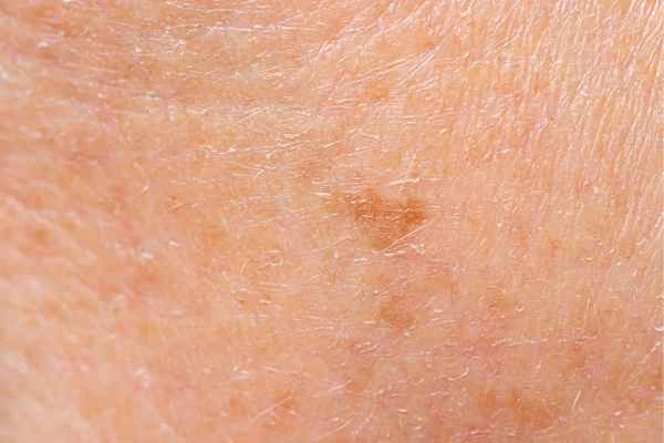 close up picture of age spots Godalming
