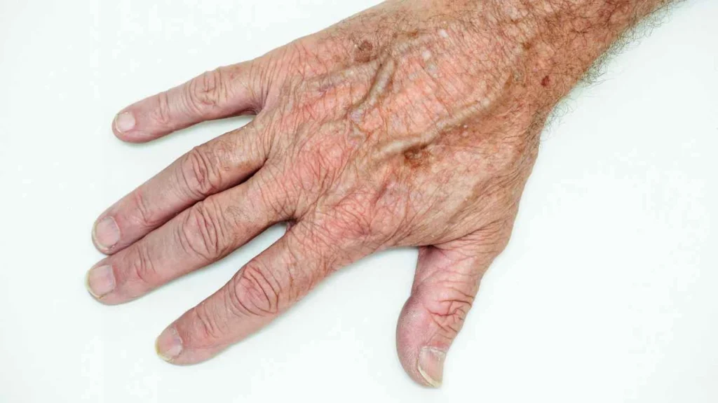 Male hand showing age spot Godalming