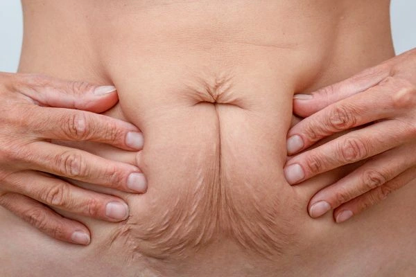 Image of a woman's stomach with loose skin - example of skin tightening Godalming options
