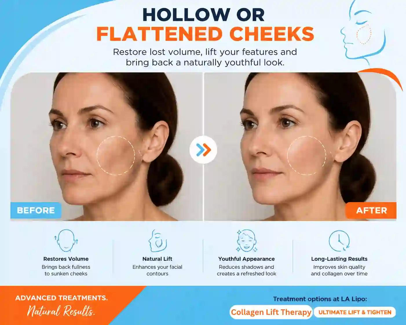 Sign #4: Hollow or Flattened Cheeks Godalming